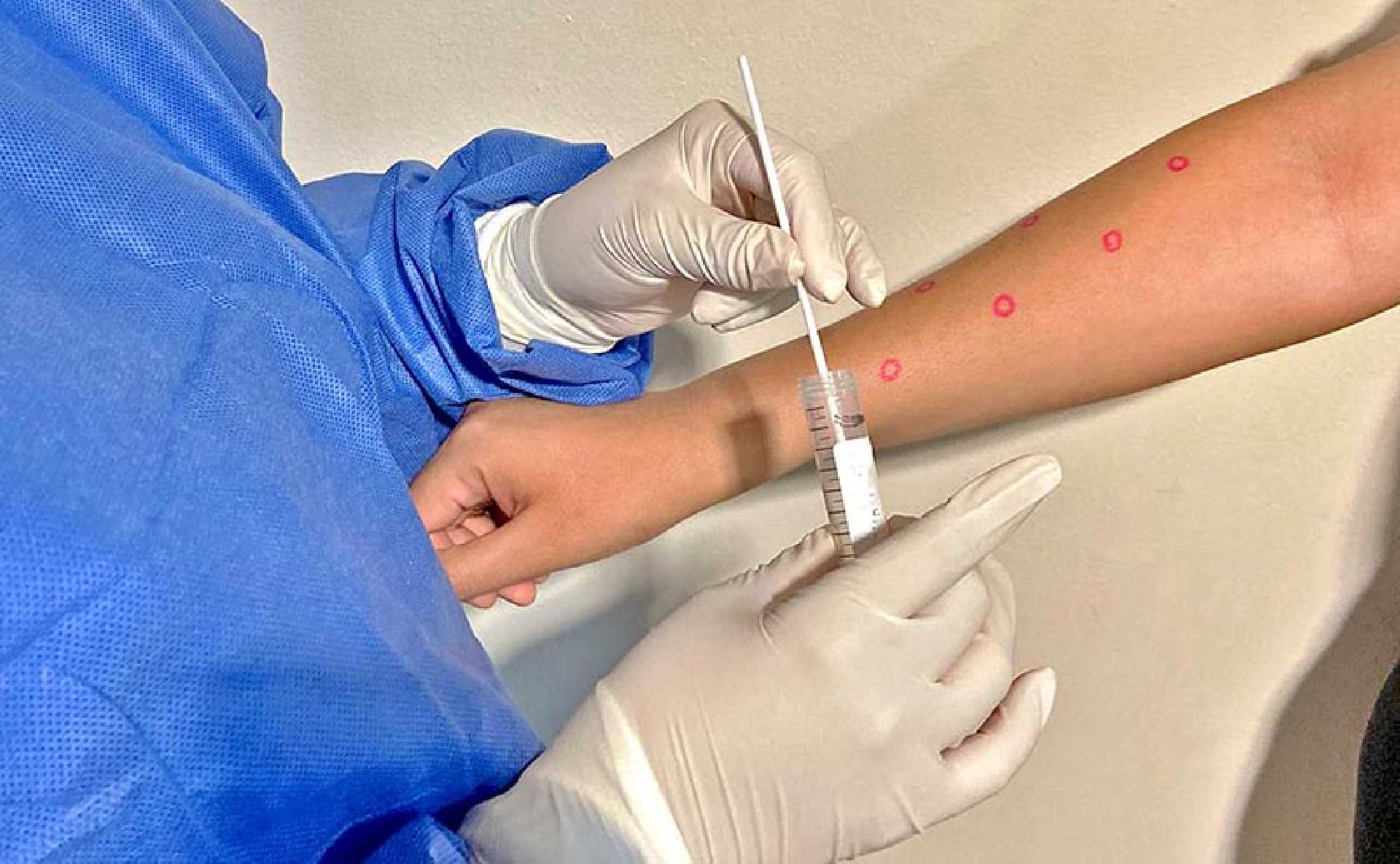 REPORTA SALUD ESTATAL UN NUEVO CASO DE VIRUELA SÍMICA